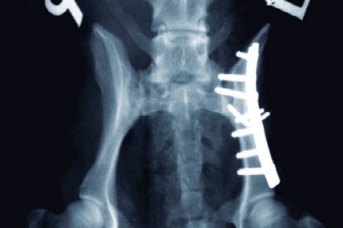 pelvic fracture example